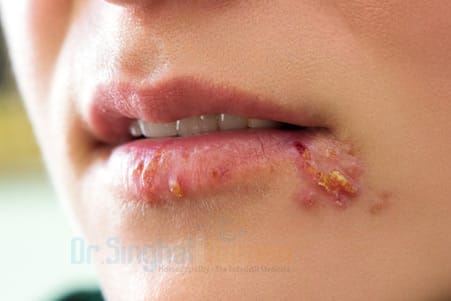 Homeopathic Treatment for Herpes | Safe & Natural Relief