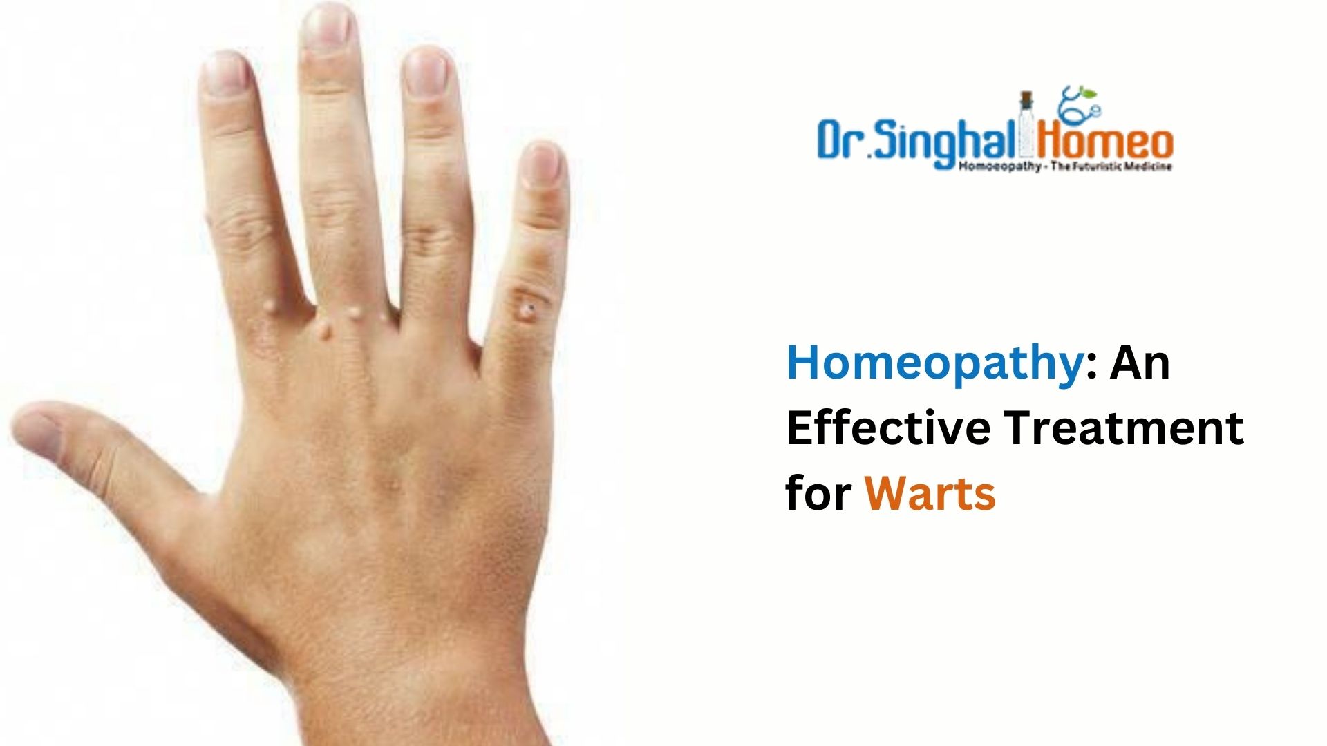 Finding Relief: Exploring Warts  Homeopathy Medicine