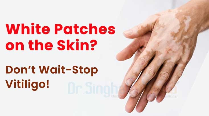 Finding Hope: Your Guide to Expert Vitiligo Treatment with Homeopathy | by Dr. Singhal Homeo | Sep, 2025 | Medium