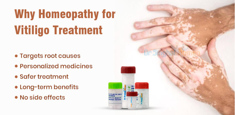 Gentle Healing Approaches for Leucoderma and Vitiligo with Homeopathy