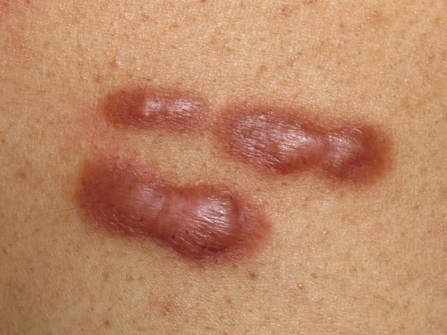 Get Safe & Effective Treatment for Keloids in Homeopathy
