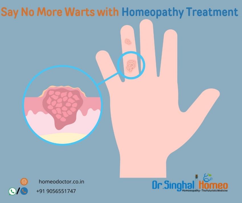 Find the Best Homeopathic Treatment for Warts with Dr. Vikas Singhal | daddycow.com