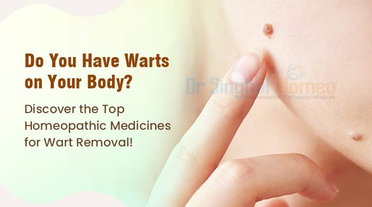 Best Homeopathy Medicine for Warts | Fast Relief