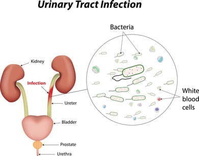 Effective Homeopathic Treatment for UTI with Best Results