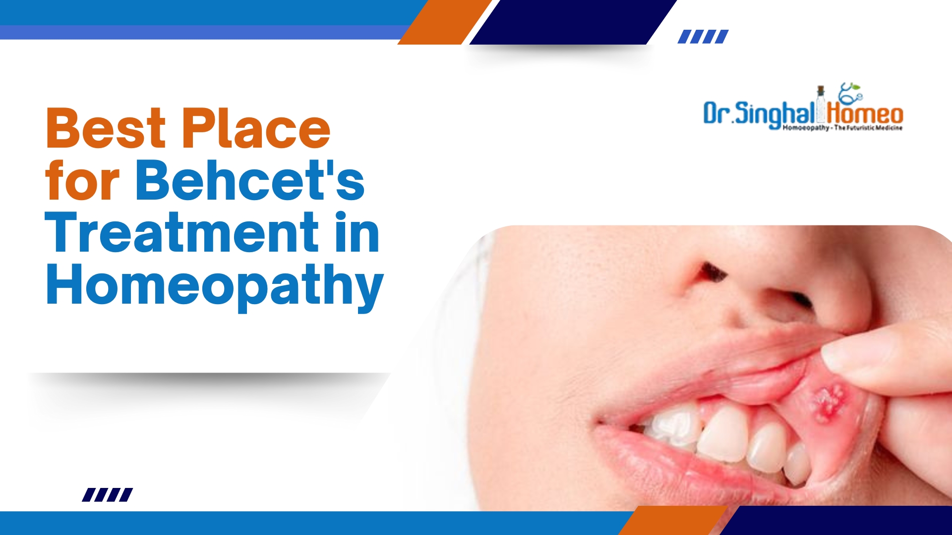 Homeopathic Treatment for Behçet’s Disease: Dr. Vikas Singhal’s Expert Approach to Comprehensive Care – health