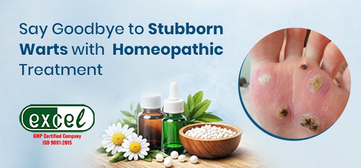 Homeopathic Wart Removal Treatment | Safe & Natural Care
