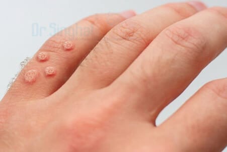 Natural Homeopathic Treatment for Warts | No Pain, No Scars