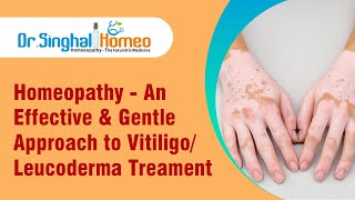 Vitiligo/Leucoderma By Dr. Vikas Singhal