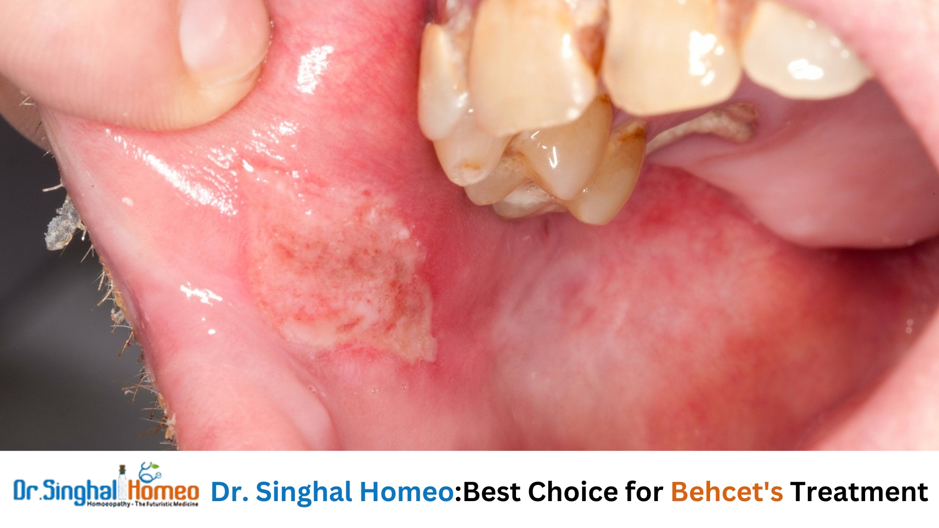 Behcet’s Disease Treatment Through Homeopathy: A Comprehensive Medical Overview – health
