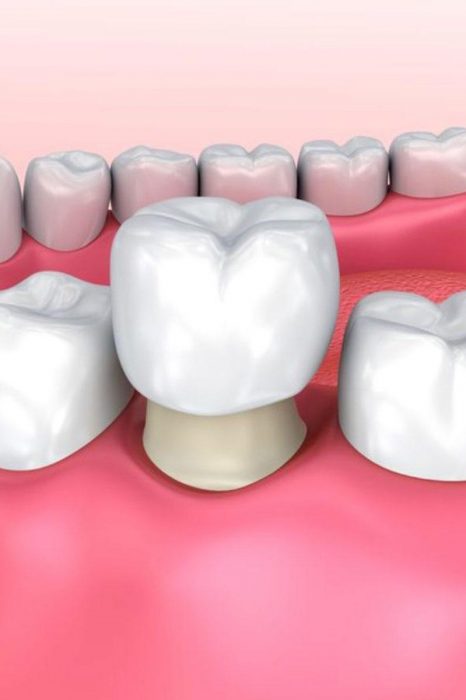 Dental Crown – Smart Smile Dental Clinic