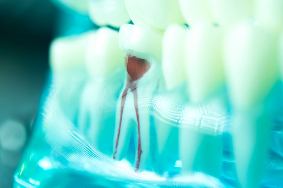 Root Canal Treatment in Chandigarh | Dantaa Dental Clinic
